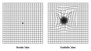 The Amsler grid or Amsler network is a simple function test for AMD age-related macular degeneration